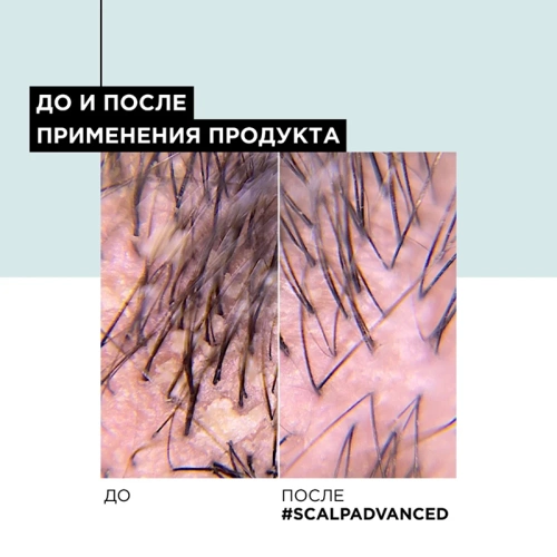 Шампунь от перхоти / SCALP ADVANCED 300 мл фото 7